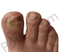 Tratamientos podológicos Onicomicosis