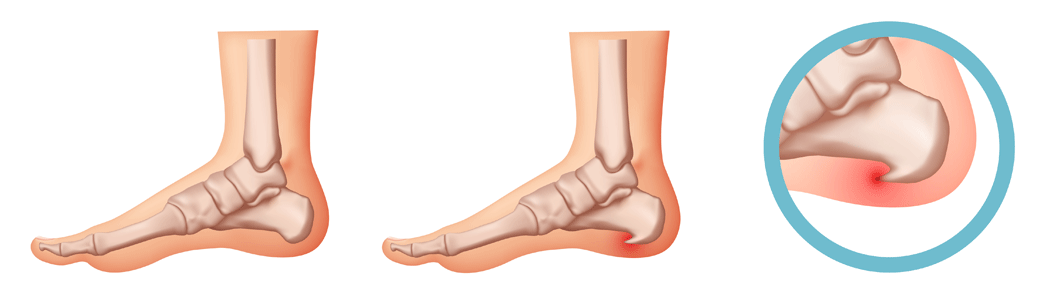 Fascitis Plantar proceso