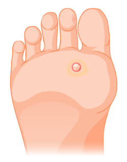 Verruga Plantar