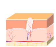 ilustracion ampliada de Verruga plantar