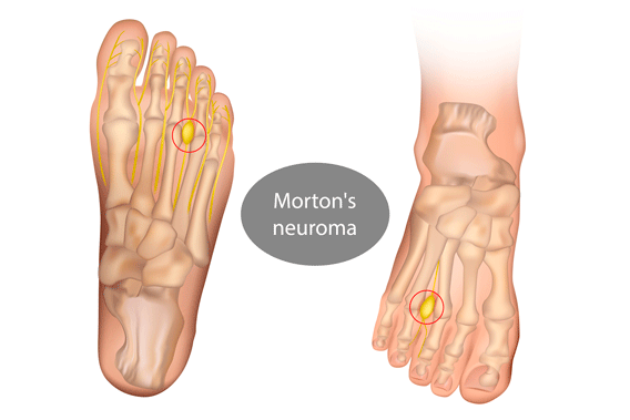 neuroma de morton