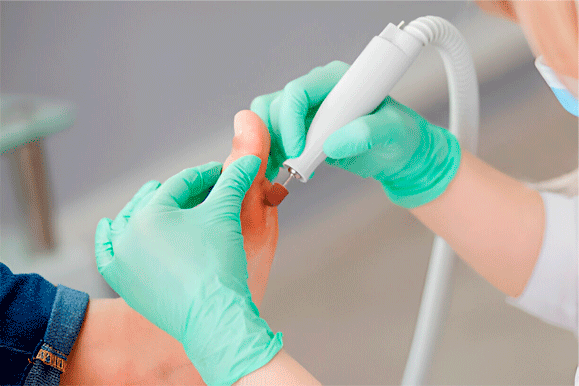 podologo barcelona realizando tratamiento de callo plantar en clinica de podologia barcelona