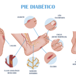 Característica del pie diabético