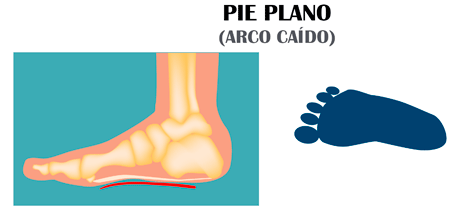 Pie Plano - Huella Plantar