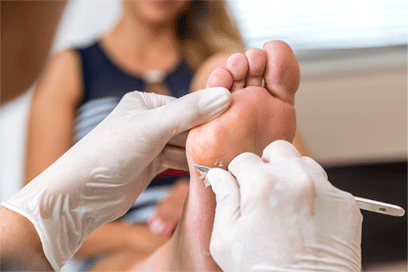 podologo barcelona  quitando duricias del pie en clinica de podologia barcelona