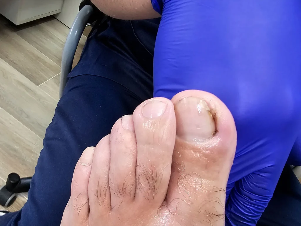 Uña encarnada antes de cirugía de matricectomía en clínica podológica en Barcelona