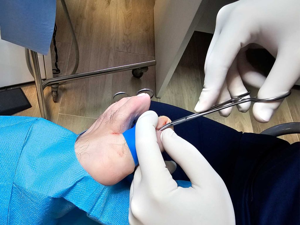 Extracción del borde lateral de la uña durante una cirugía de uña encarnada (matricectomía) en clínica podológica de Barcelona
