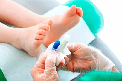 Podólogo infantil en Barcelona realizando tratamiento podológico en PODODERM