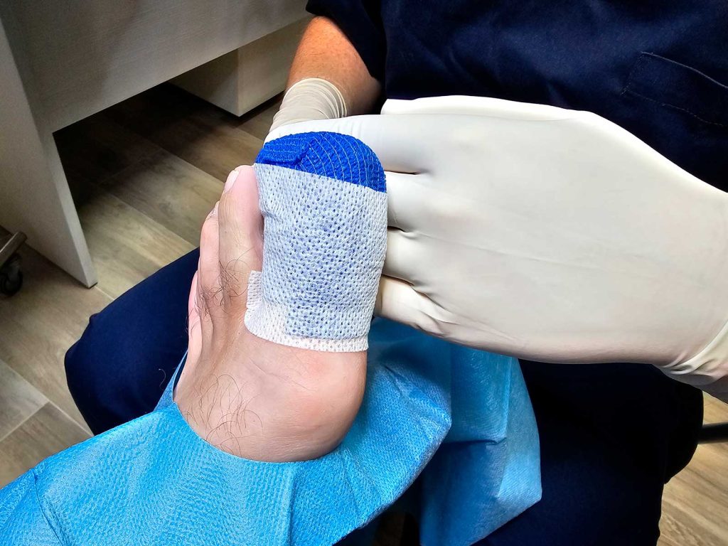 Vendaje postoperatorio tras cirugía de uña encarnada mediante matricectomía en clínica podológica de Barcelona